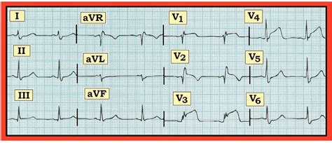 ECG Interpretation: ECG Interpretation Review #82 (Acute STEMI – RCA ...