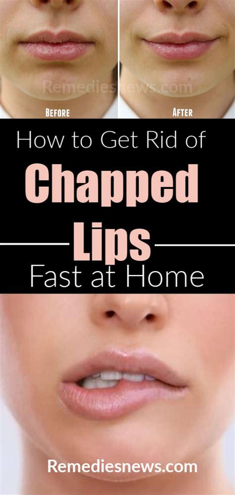 7 Natural Remedies To Get Rid Of Chapped Lips Fast At Home