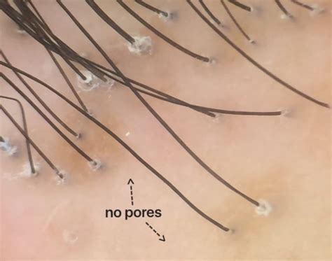 Lichen Planopilaris A Classic Example Of Scarring Alopecia — Donovan Hair Clinic