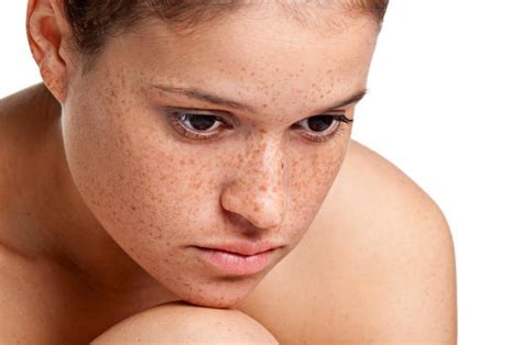 Skin Tags Causes