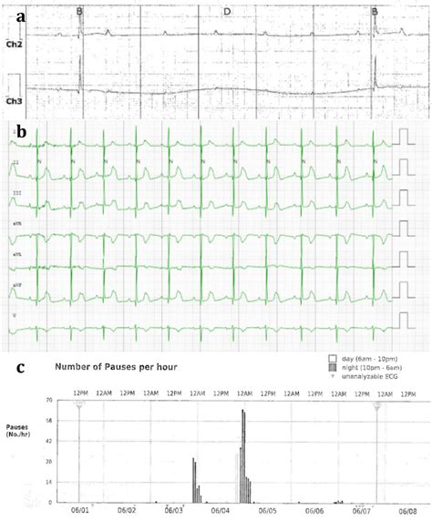 Clinical Data From Case 1 A A Strip From Initial Holter Monitor