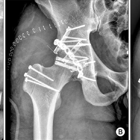 The Preoperative And Postoperative Range Of Motion And Grip Power