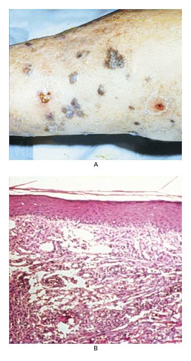 Kaposis Sarcoma Nejm