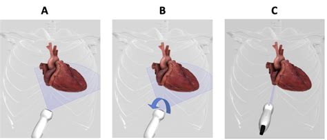 Inferior Vena Cava Point Of Care Ultrasound Openanesthesia