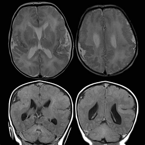 Polymicrogyria | Pediatric Radiology Reference Article | Pediatric ...