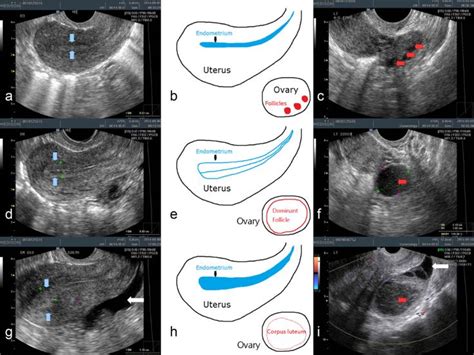 Detection of ovulation, a review of currently available methods - Su ...