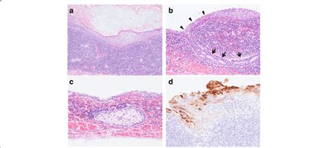 Pathological Findings A Cyst Surrounded By Squamous Lined Epithelium