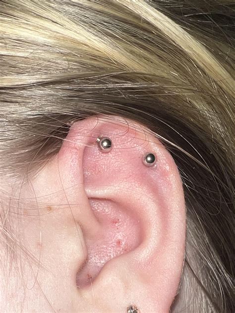 Keloid Or Piercing Bump R Piercing