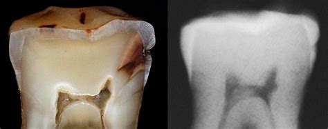 Preventing Tooth Decay: Early Signs and Symptoms