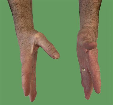 Rupture Of The Extensor Pollicis Longus Epl Tendon Lothian Virtual