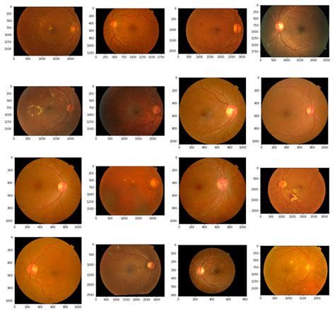 Github Muditbhartia Diabetes Retinopathy Detection Using Machine Laearing