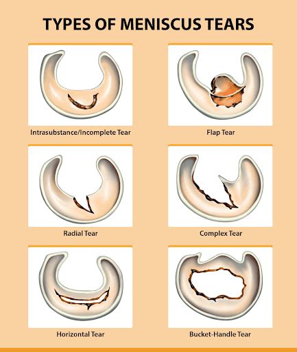 Physical Therapy For Meniscus Tear Injuries The Game Plan Physical Therapy