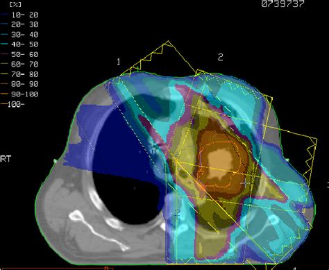 An Axial CT Slice And The Dose Distribution From The IMRT Plan Used In