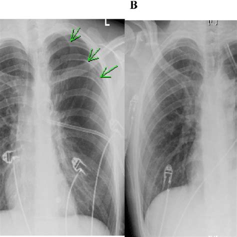 A Initial Anterior Posterior Chest Radiograph At Presentation Showing