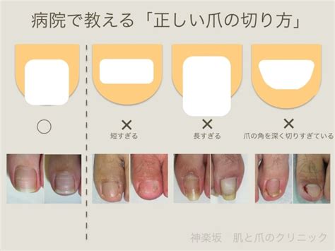 病院で教える正しい爪の切り方 皮膚・爪・髪の病気 All About