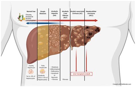 Understanding Alcohol Related Liver Disease Ask The Nurse Expert