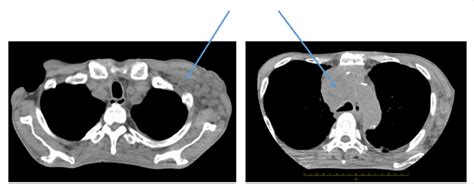 Chest CT shows mediastinal lymphadenopathy (arrow). | Download ...