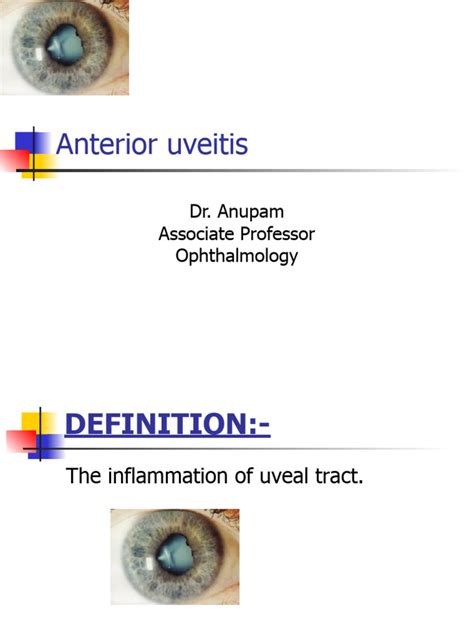 Anterior Uveitis Pdf Glaucoma Cornea