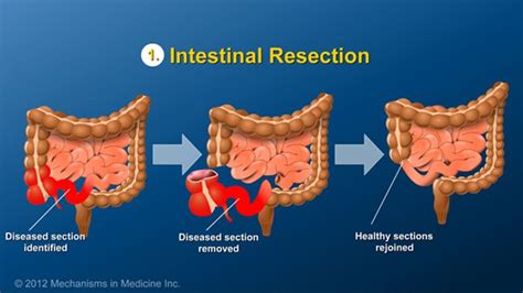 Pin On Surgery And Ibd