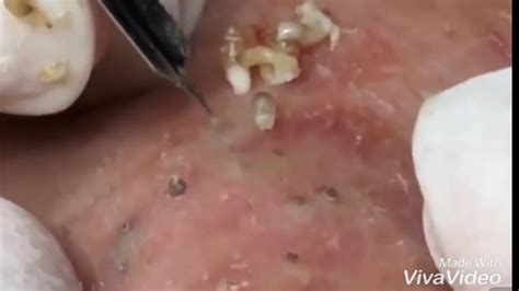 Dr Pimple Popper Blackhead Extraction Pops At William Frazier Blog