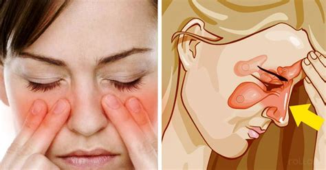 Como Curar Una Sinusitis En S Lo Segundos Con Este Remedio Casero