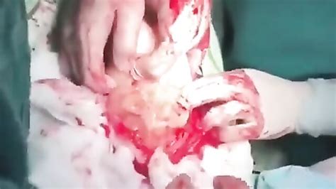 Doctors Remove Very Big Dildo Sex Toy From Womans Body 12Vids