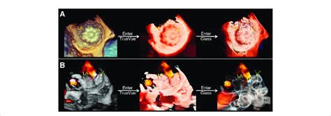 Three Dimensional Transesophageal Echocardiography Plus Color Doppler