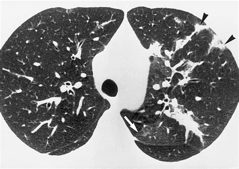 Viral Pneumonias In Adults Radiologic And Pathologic Findings Radiographics