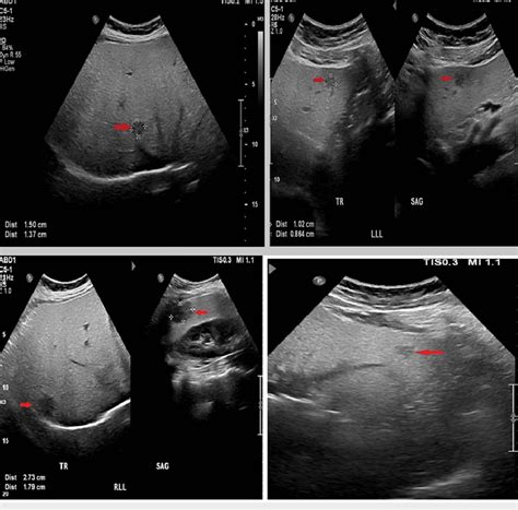 multiple liver ultrasound images   reveal hyperechoic diffuse fatty