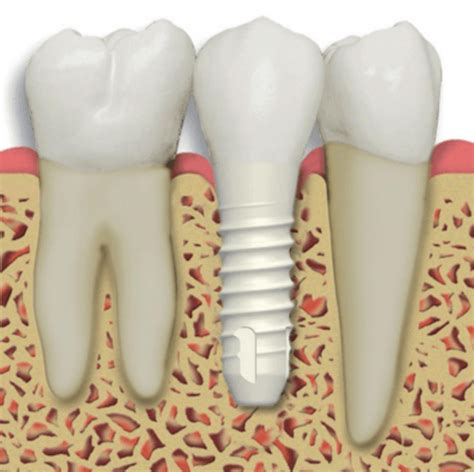 Dental Implant Center Los Angeles | LA Periodontists