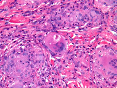 Sarcoidosis (cutaneous sarcoidosis)