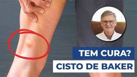 O Que Cisto De Baker Ou Cisto Na Popl Tea Sintomas Diagn Sticos E