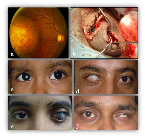 Cosmetic Rehabilitation Of The One Eyed Custom Made Ocular Prosthesis Eyetoday