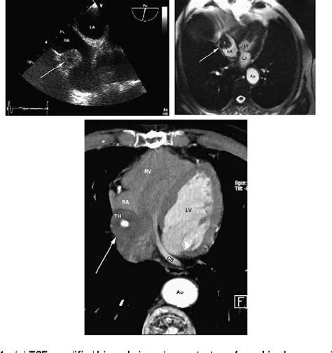 Figure From Multimodality Imaging In The Management Of Aorto Coronary