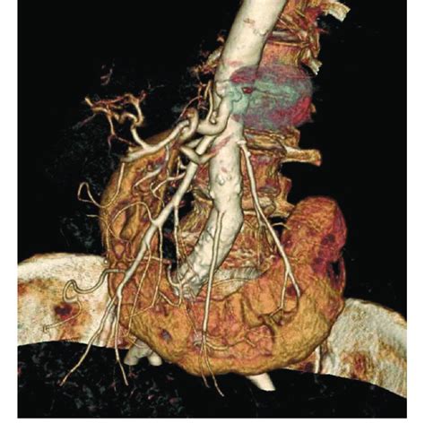 Giant rupture of splenic artery aneurysm (SAA) with patency of the ...