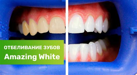 Отбеливание зубов Amazing White в стоматологии Киви Дент