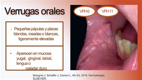 Virus Del Papiloma Humano Pptx