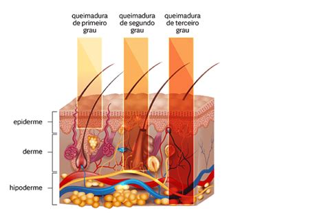 Queimadura Solar O Que Fazer - Queimadura de sol: o que fazer e como evitar | Nav Dasa