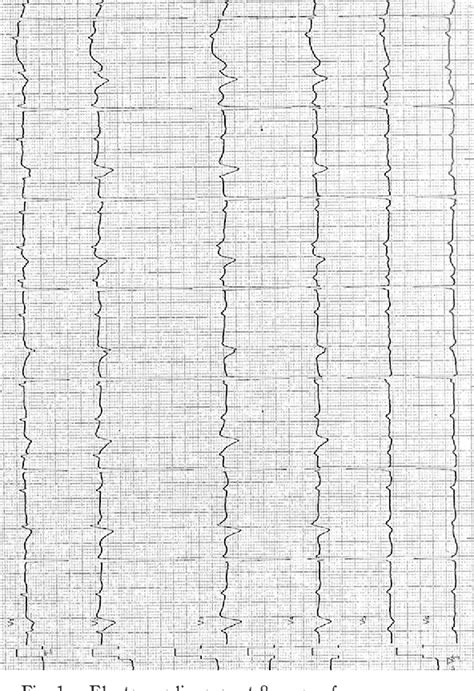 Figure 1 From Follow Up Of Isolated Congenital Complete