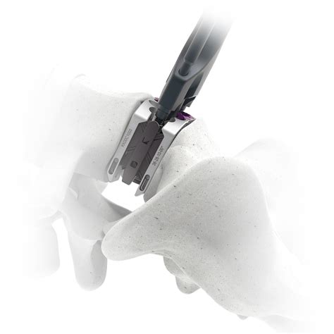 Astura Medical Announces Initial Case and Full Commercial Release For