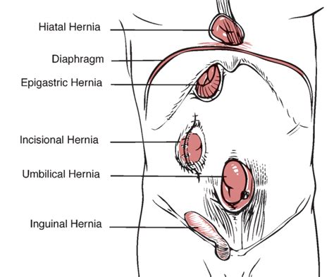 Robotic Hernia Surgery Longview Weight Loss Longview