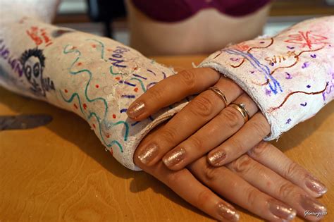 Arm Casts