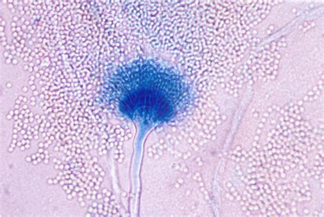 A Terreus Archives Page 2 Of 3 Aspergillus And Aspergillosis