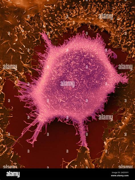 Human lung epithelial cancer cell among healthy epithelial cells ...