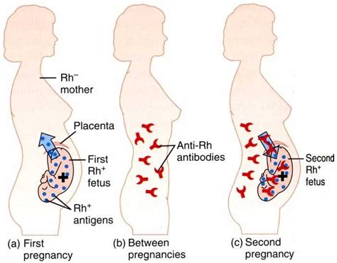 Hemolytic disease of newborn | Nursing notes, Midwifery, Medical questions