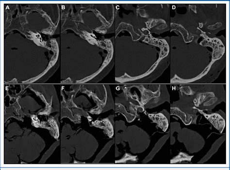 Figure 4 From Microsurgical And Endoscopic Anatomy Of The Extended