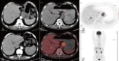 Frontiers Case Report Complete Remission Of A Patient With