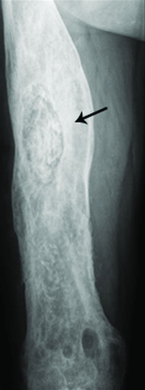 Chronic Osteomyelitis On Plain Radiograph Of The Femur Plain