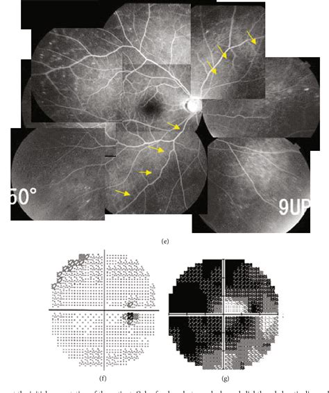 Figure From Retinal Pigment Epithelial Tears After Ex Press