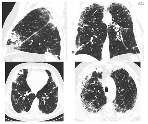 Diagnostics Free Full Text Pulmonary Fibrosis Related To Amiodarone